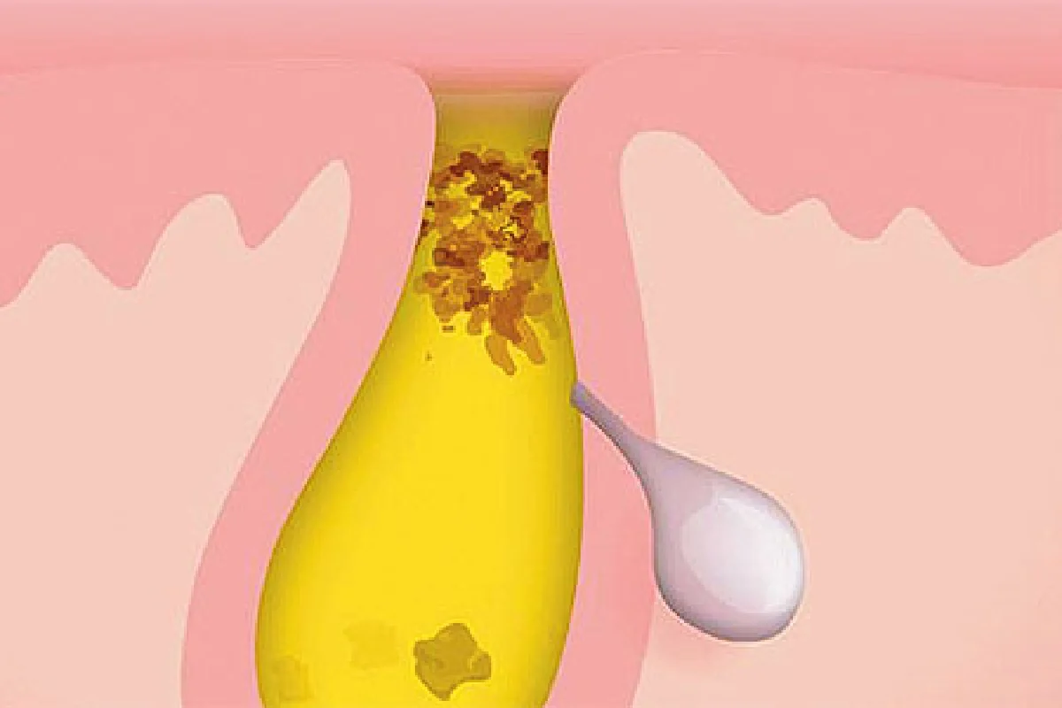 วัยไหนๆ ก็ห่างไกลสิว