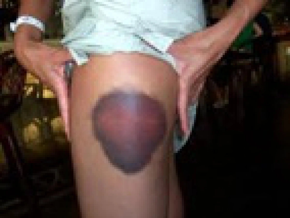 bruise