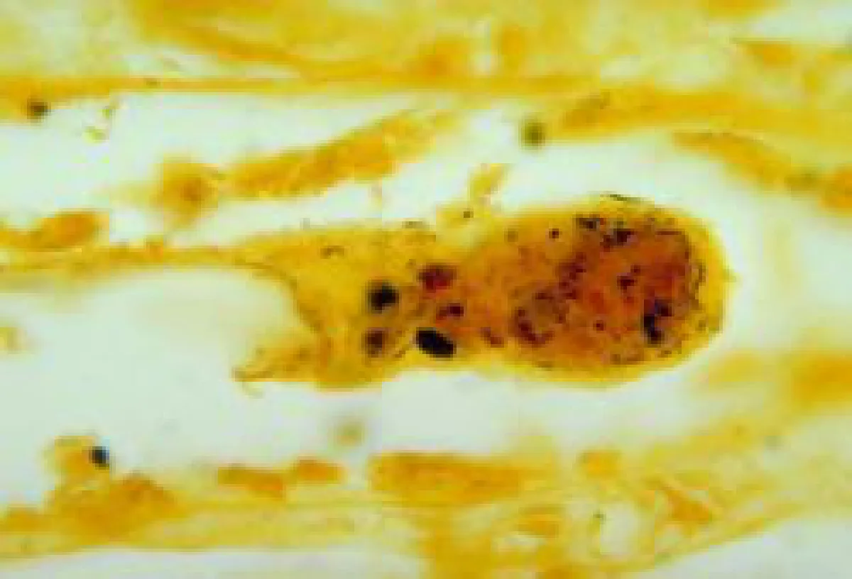 leptospirosis in the kidney