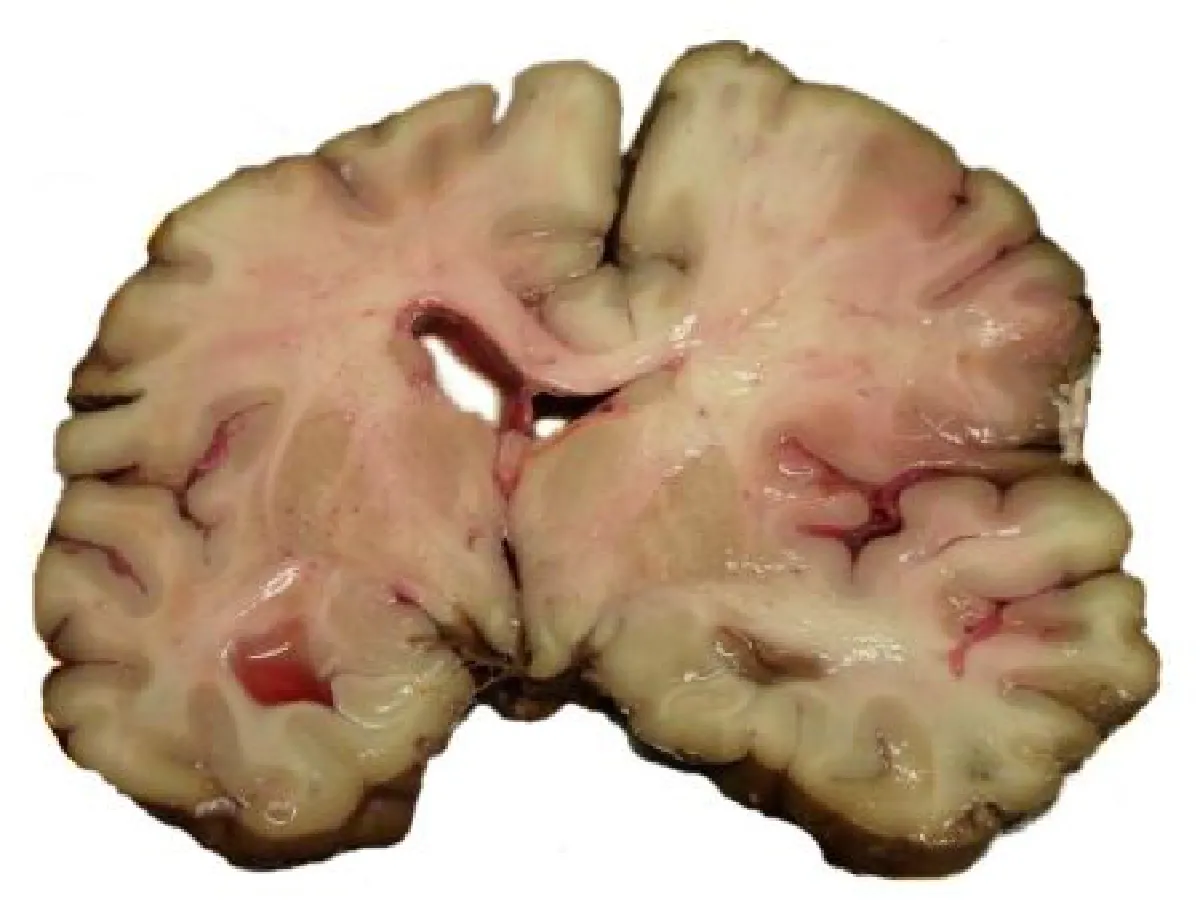 stroke brain