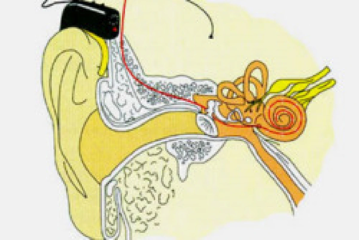 หมอเตือนแคะ-ปั่นหูมากระวังหูตัน-หนวก