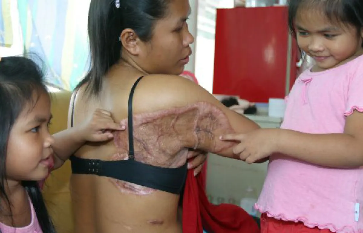 Scars: How to get rid of them