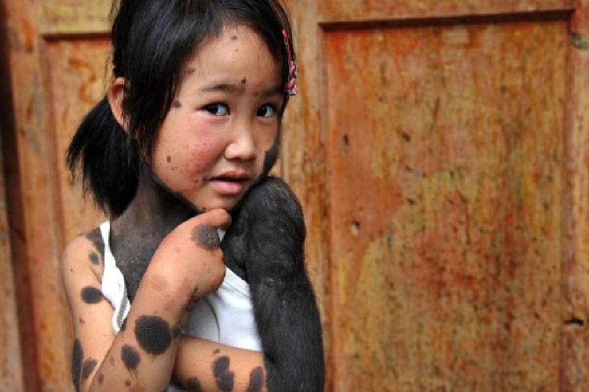 เด็กหญิงจีนได้รับการรักษาปานดำแล้ว