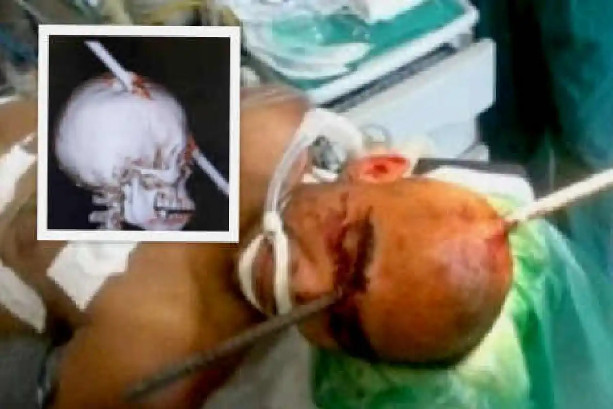 หนุ่มบราซิลถูกเหล็กเสียบหัวรอดตายหวุดหวิด