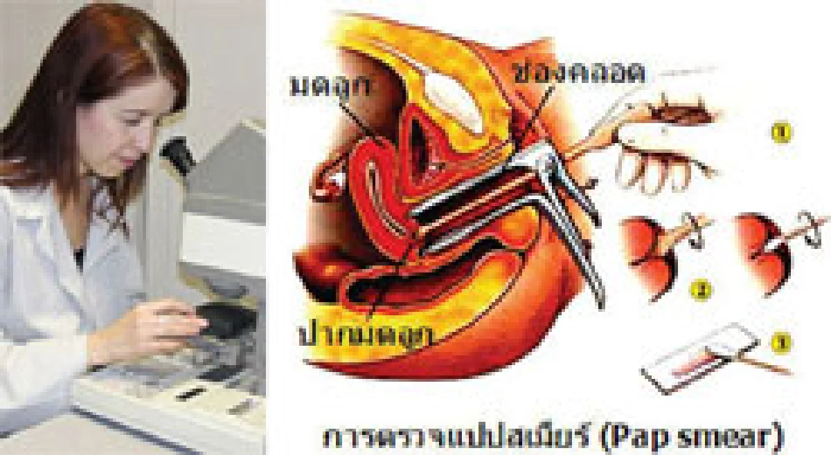 ตรวงจมะเร็งมดลูกเองแม่นยำ100%