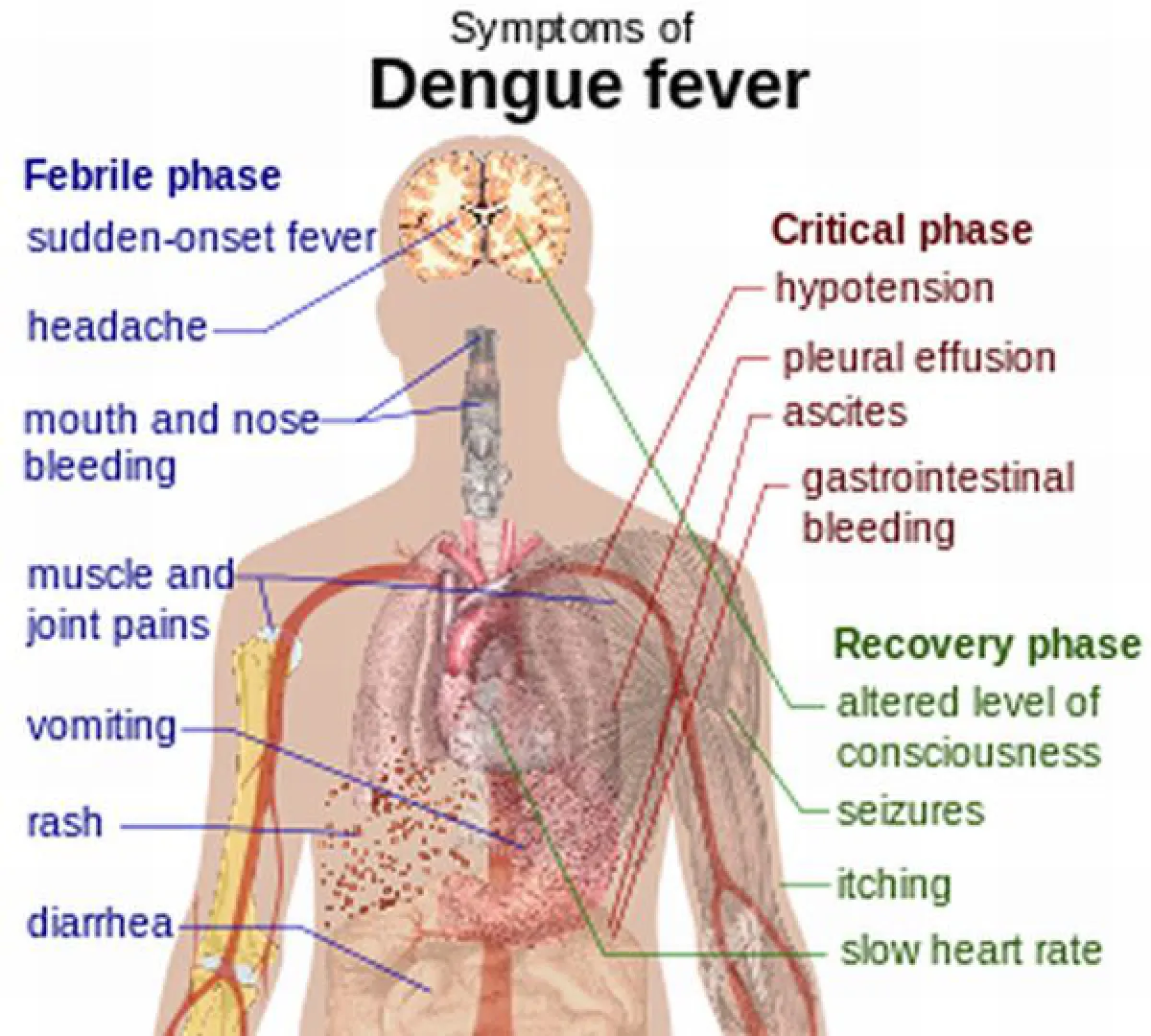 Dengue death of 12-year old: Wrong diagnosis