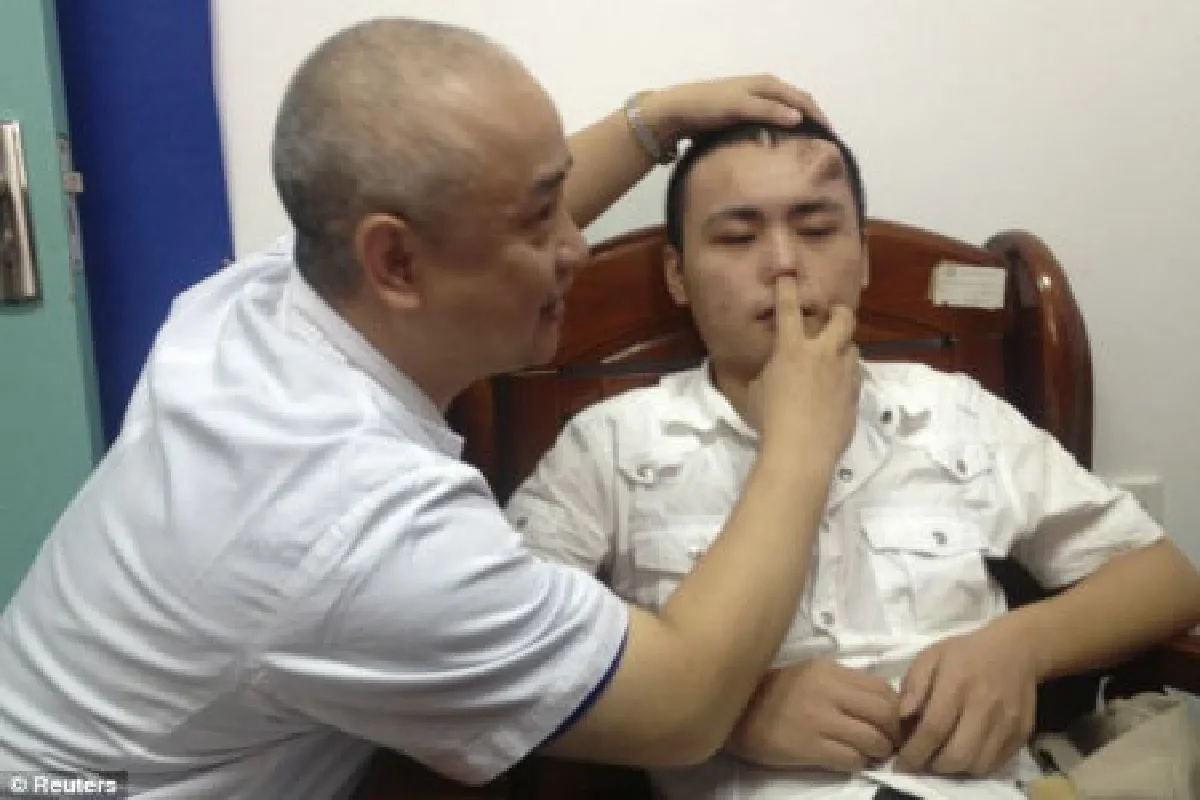 ชายจีนปลูกถ่ายจมูกใหม่บนหน้าผาก