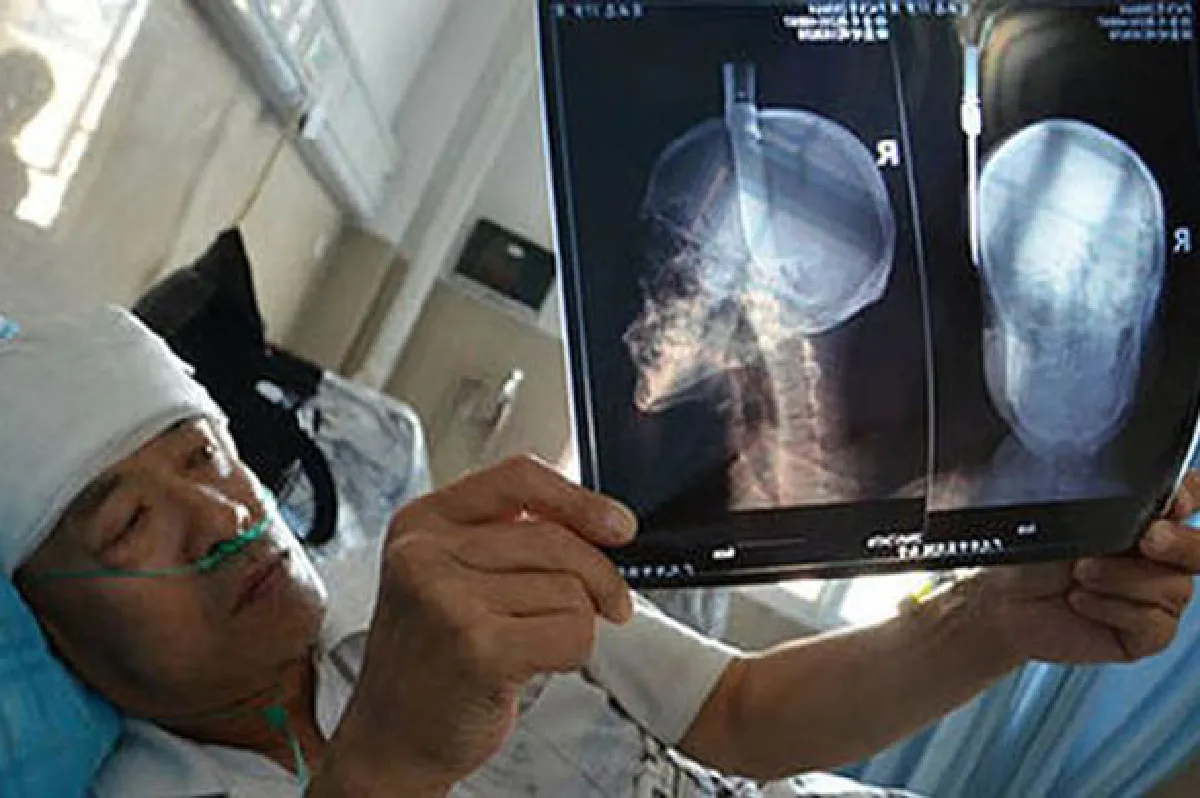 สยอง!ชายจีนเดินอยู่ดีๆ เจอมีดหล่นปักหัวทะลุกะโหลก