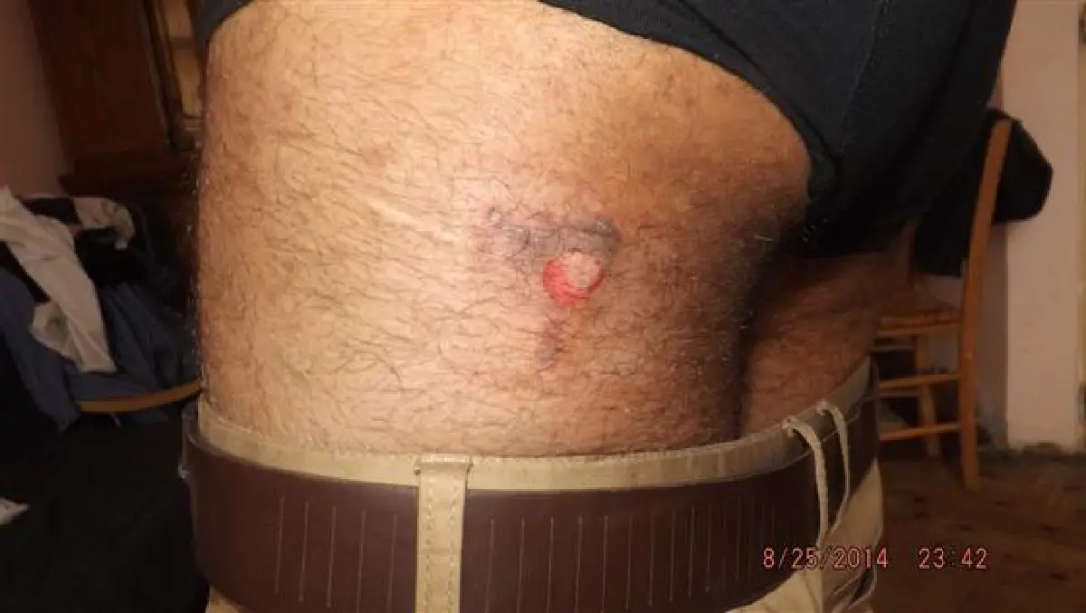 อีกแล้ว!มือถือระเบิดทะลุเคสคากระเป๋ากางเกง