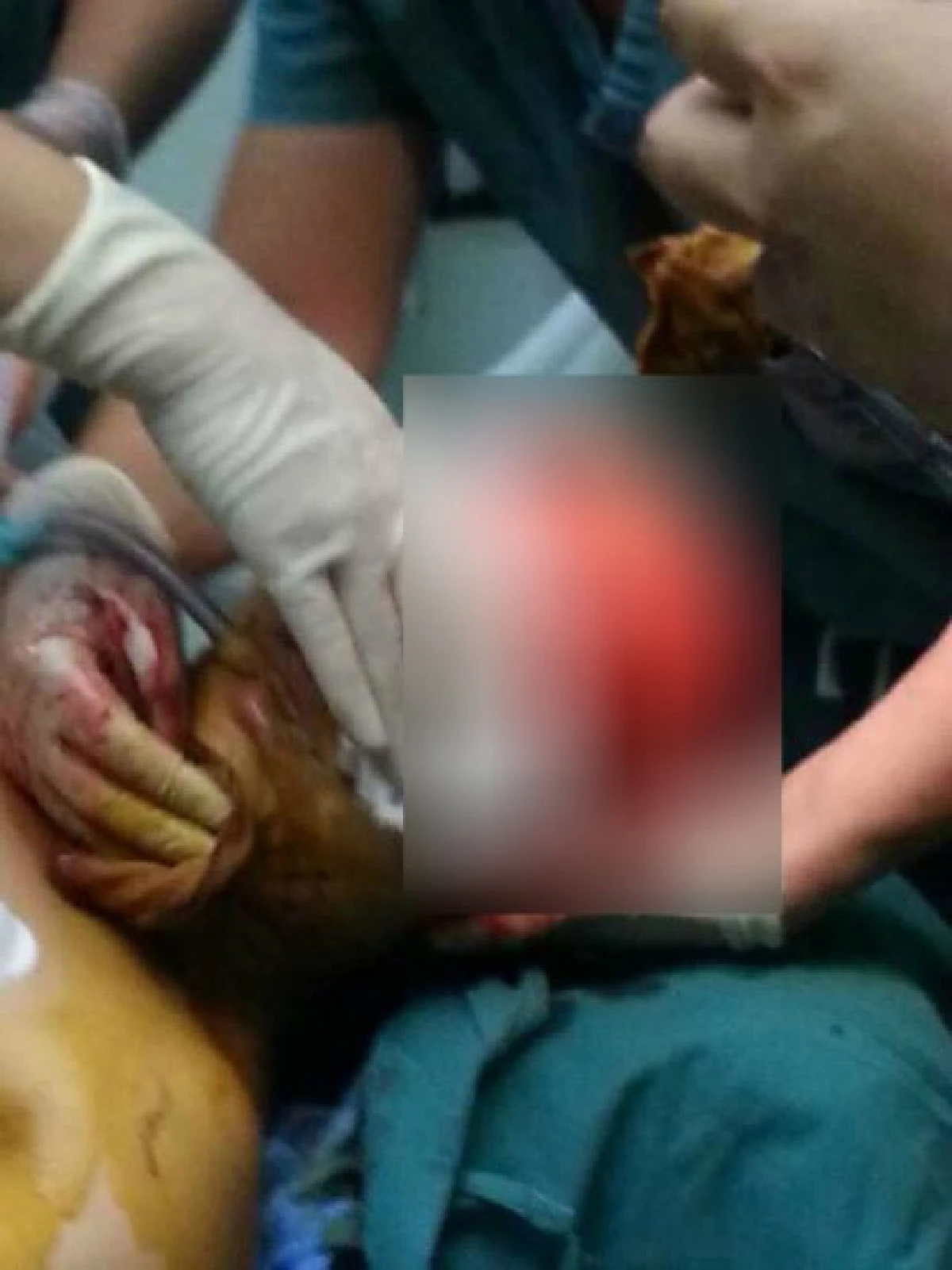 สุดสยอง!สาวจีนถูกเครื่องจักรถลกหนังหัว