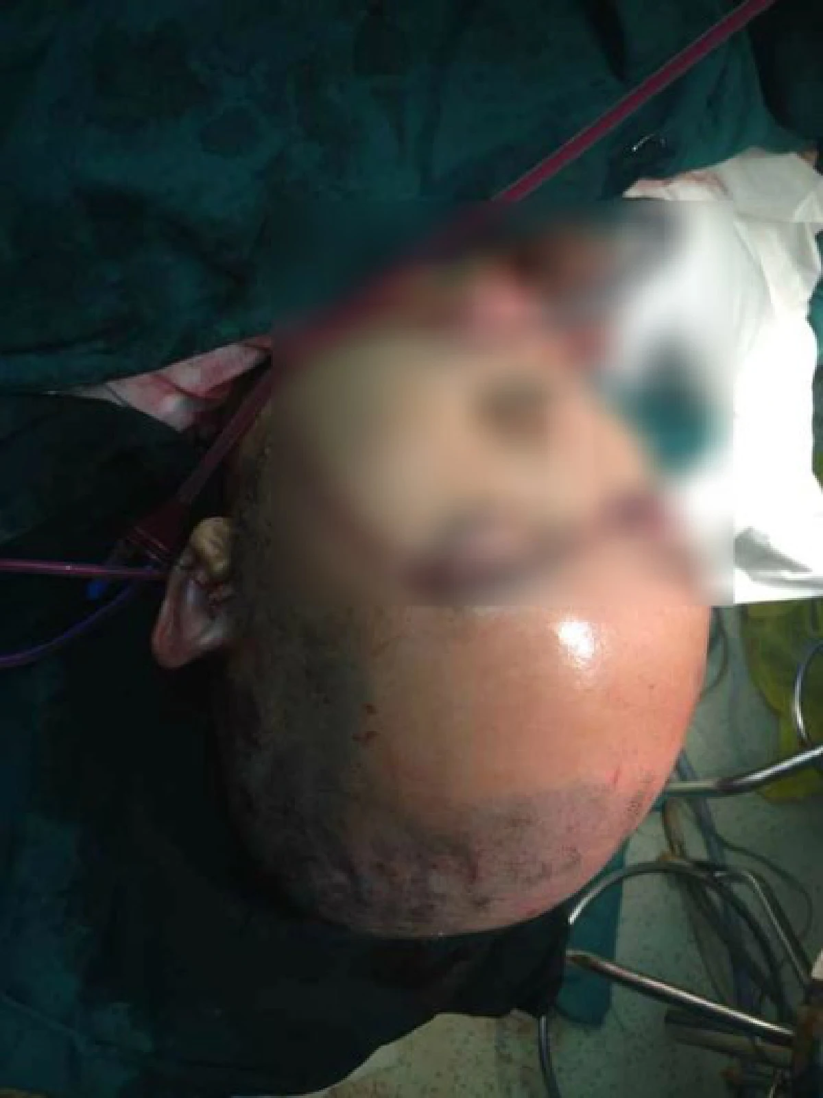 สุดสยอง!สาวจีนถูกเครื่องจักรถลกหนังหัว