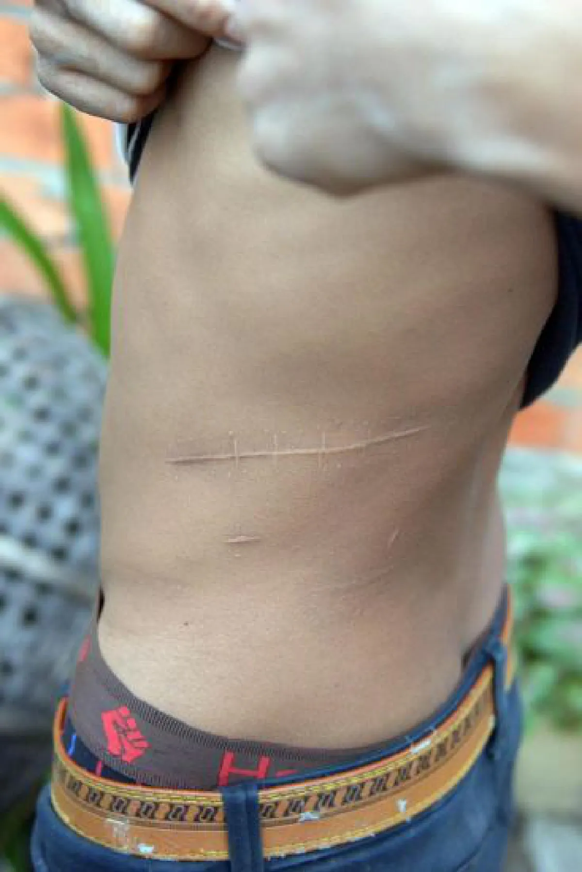 Cambodia-Thai kidney trafficking: Fears of new organ market