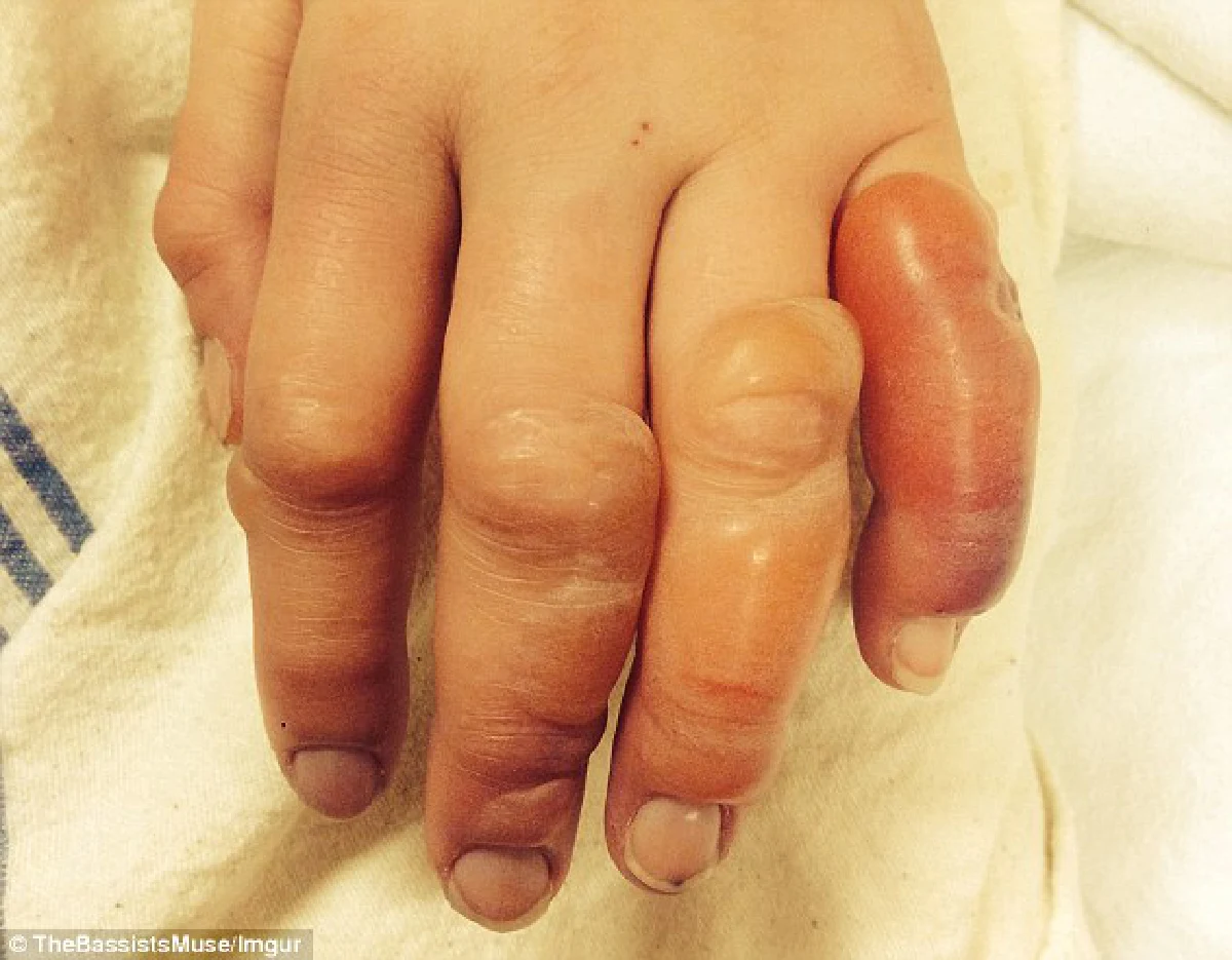 ช็อก!สาวเมาแอ๋หลับคากองหิมะ ตื่นมานิ้วบวมเป่ง