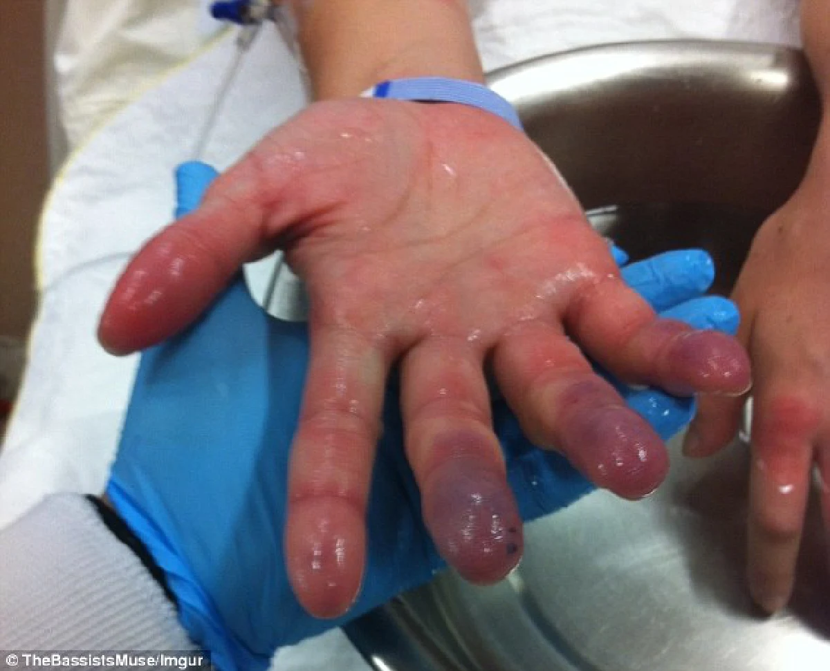 ช็อก!สาวเมาแอ๋หลับคากองหิมะ ตื่นมานิ้วบวมเป่ง