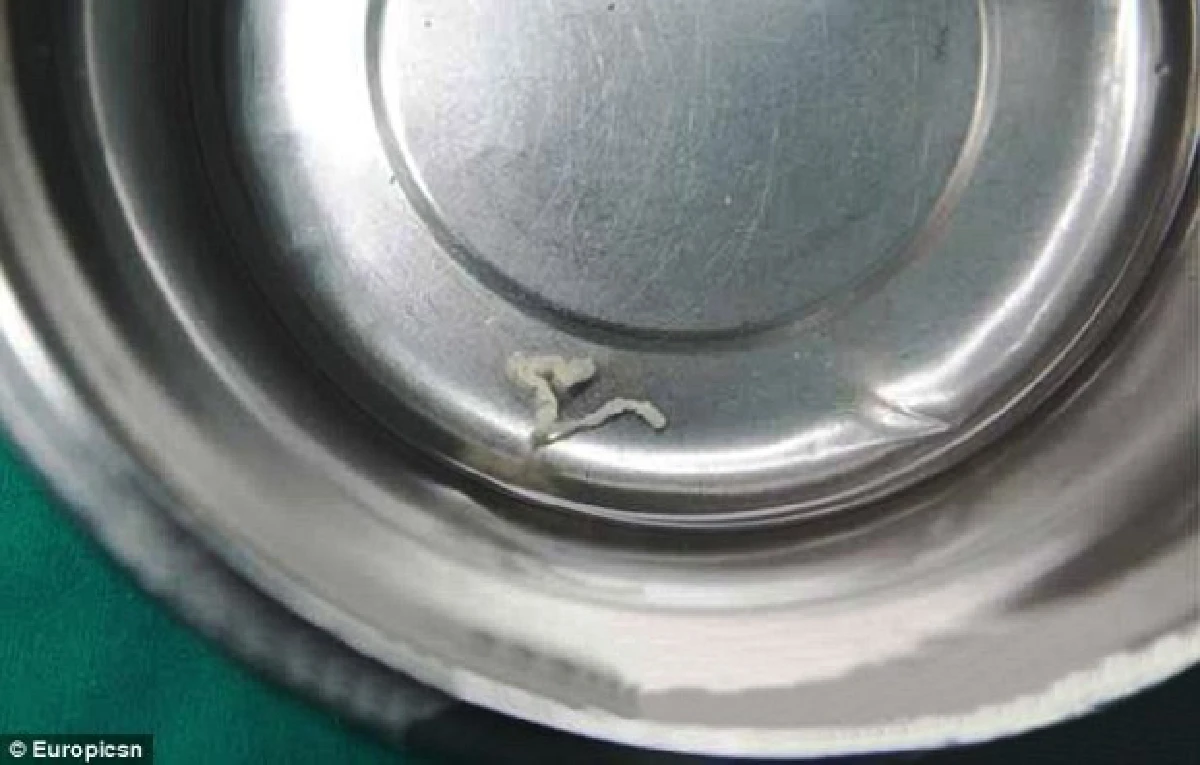 กบดิบทำพิษ!พบพยาธิไชสมองทำสาวจีนปวดหัวหนักนาน6ปี