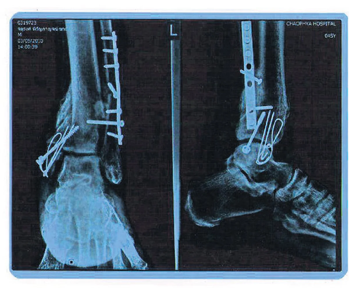 ห้วงเวลาเกือบตาย ของชายบนหลังอาน...