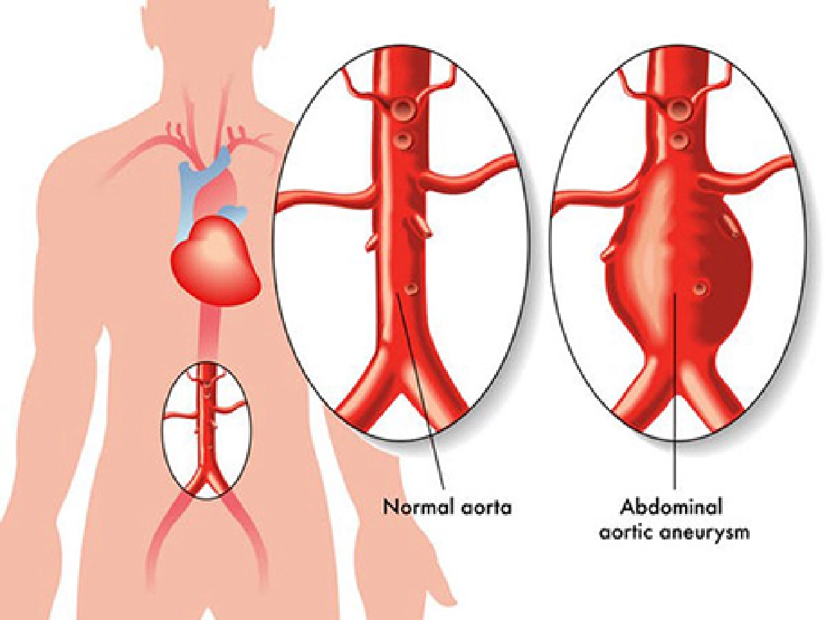 ไขความลับโรคร้ายด้วยการตรวจหลอดเลือด