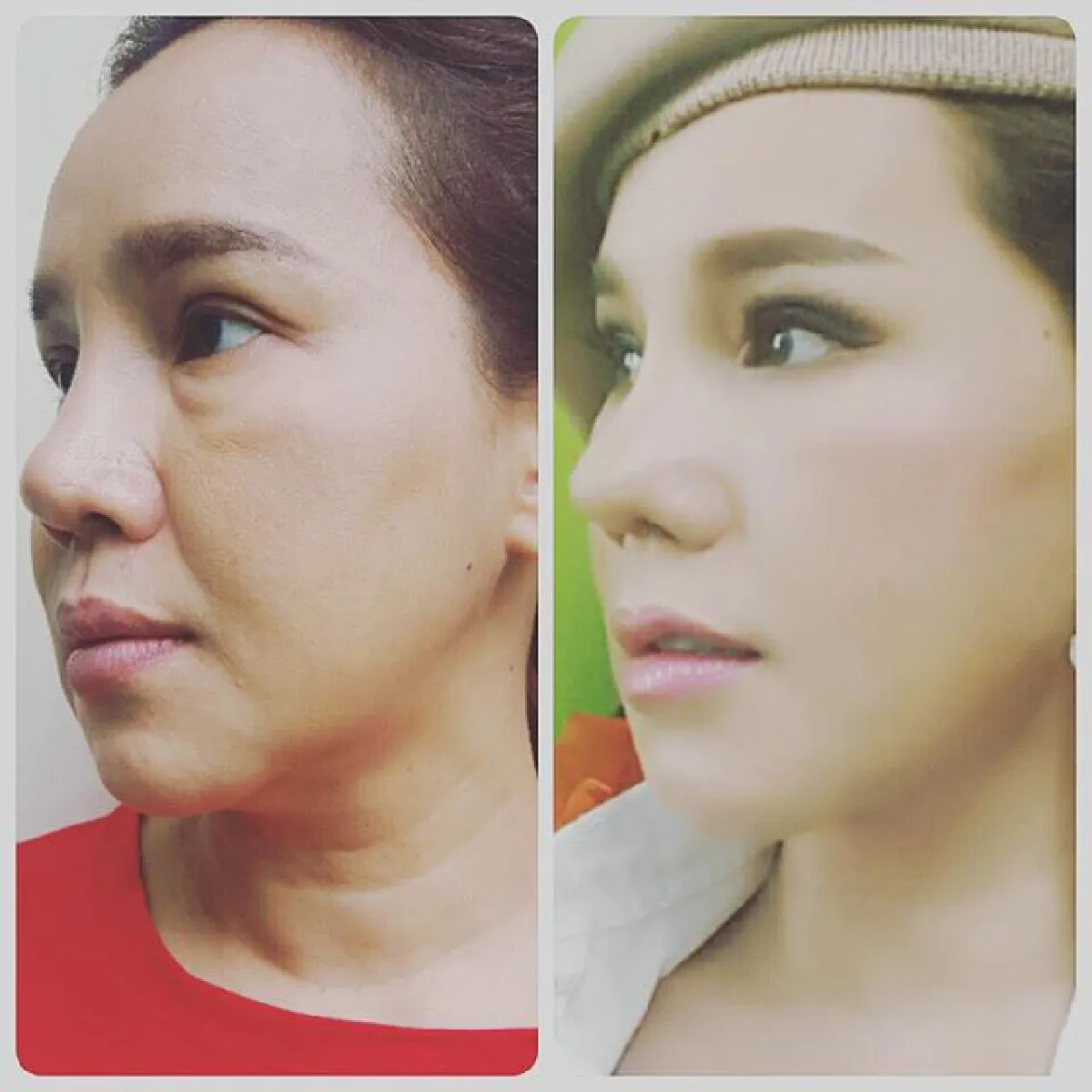 สวยขึ้นเป็นกอง! ส้มเช้ง สามช่า ศัลยกรรมอัพหน้าที่เกาหลี