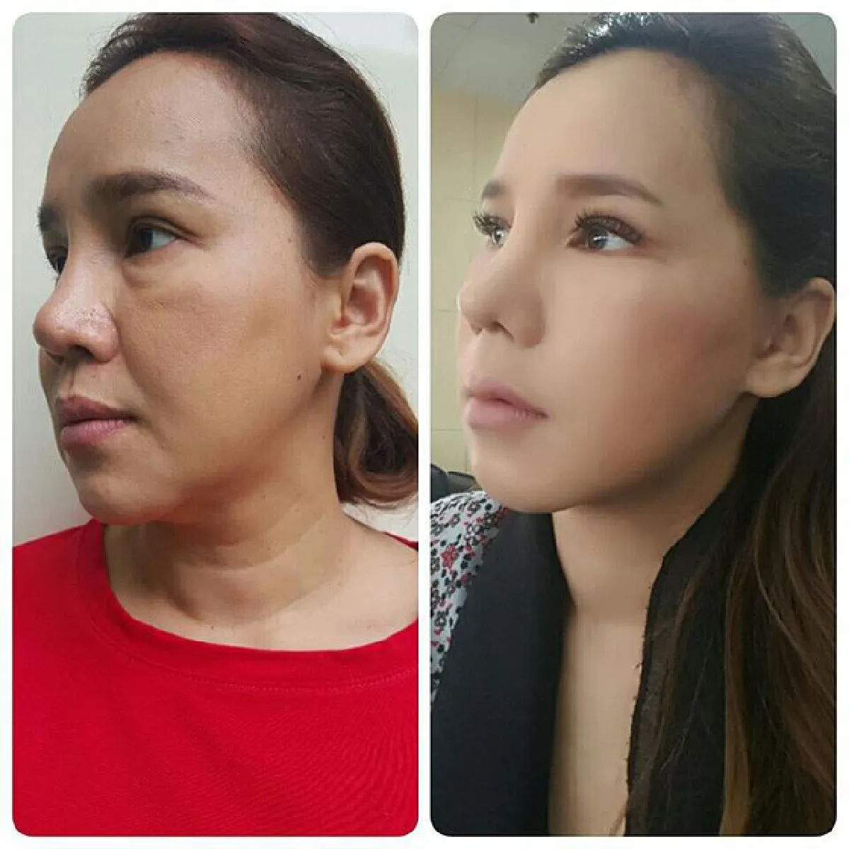 สวยขึ้นเป็นกอง! ส้มเช้ง สามช่า ศัลยกรรมอัพหน้าที่เกาหลี