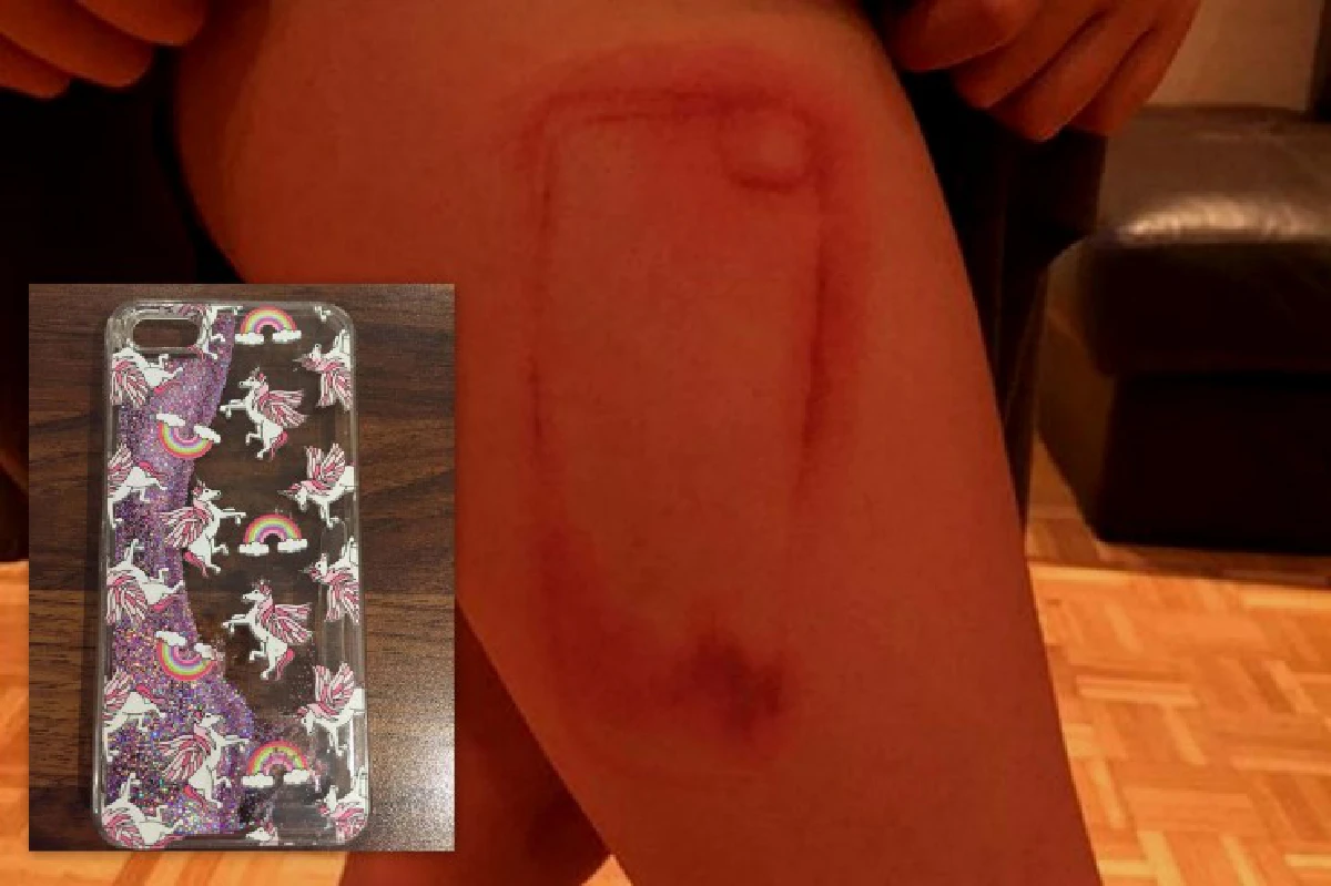 เตือน! ของเหลวใน "เคสกลิตเตอร์" อันตราย