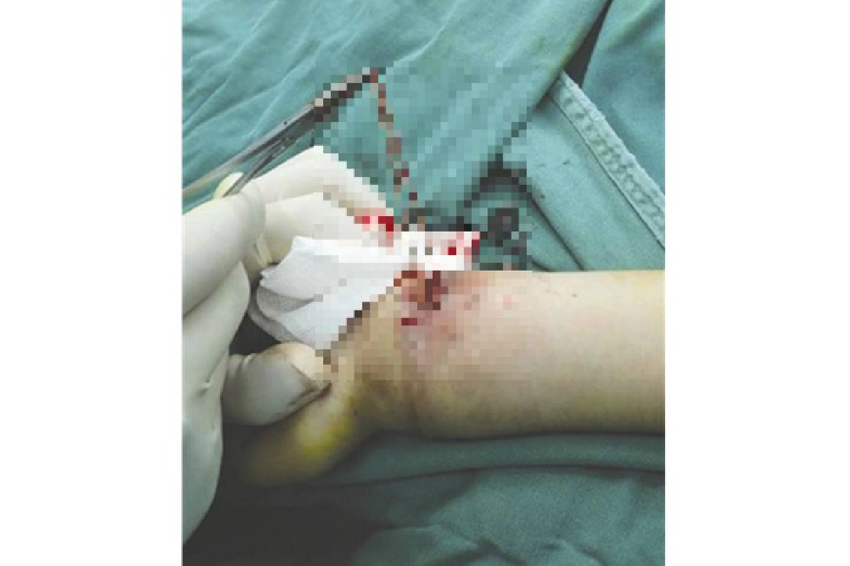 ประหลาด!แพทย์ผ่าตัดพบ"หนังยาง"ในข้อมือเด็กจีน ประหลาด!แพทย์ผ่าตัดพบ"หนังยาง"ในข้อมือเด็กจีน