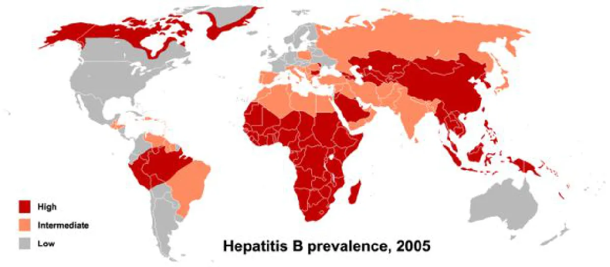 Hidden hepatitis B left untreated results in liver cancer