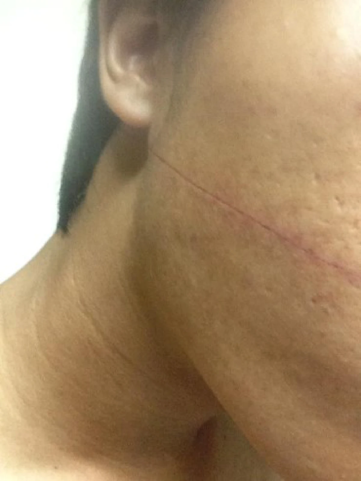 เตือนภัย!! หนุ่มเชียงราย ถูกเส้นเอ็นขึงกลางถนนบาดหน้า