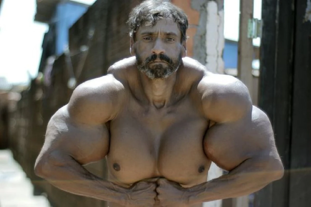 หนุ่มคลั่งกล้ามชาวบราซิล ฉีดน้ำมันเข้าร่างจนได้กล้าม 23 นิ้ว