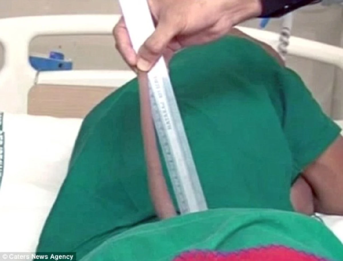 แพทย์อินเดียผ่าตัดกรณีแปลก เด็กหนุ่มวัย 18 ผู้มีหางแต่เกิด