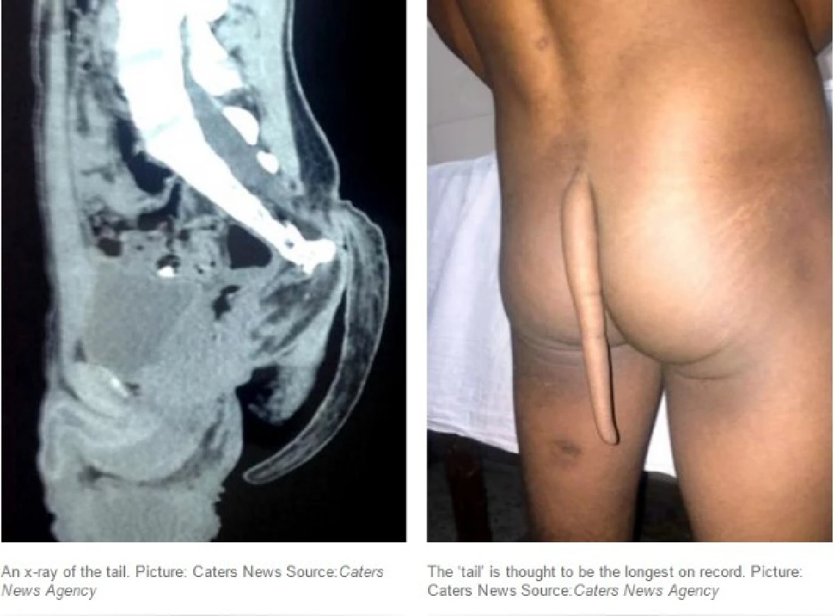 แพทย์อินเดียผ่าตัดกรณีแปลก เด็กหนุ่มวัย 18 ผู้มีหางแต่เกิด