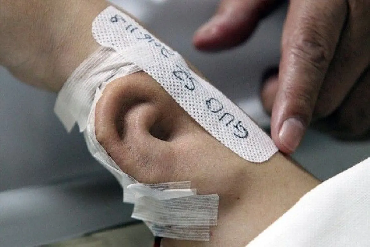 แพทย์จีนก้าวหน้า ปลูกถ่ายใบหูบนแขนผู้ป่วย