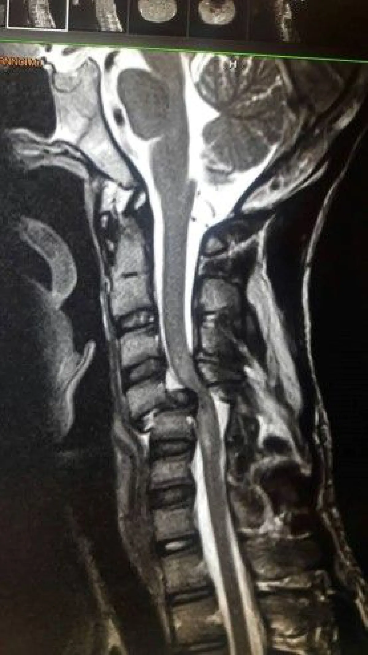 เพจดังเตือนเครื่องเล่น"แทรมโปลิน"กระโดดผิดท่าเสี่ยงอัมพาต