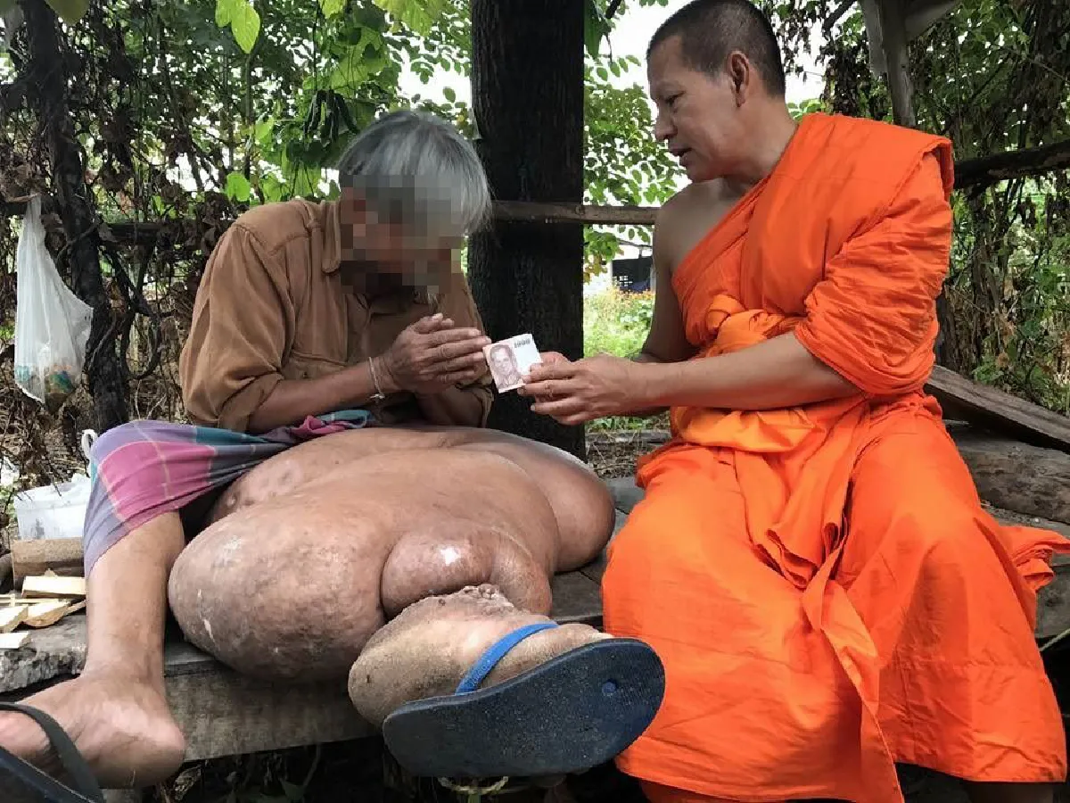 รันทด!หนุ่มป่วยโรคต่อมน้ำเหลืองอุดตันนาน10ปีจนขาบวมผิดรูป