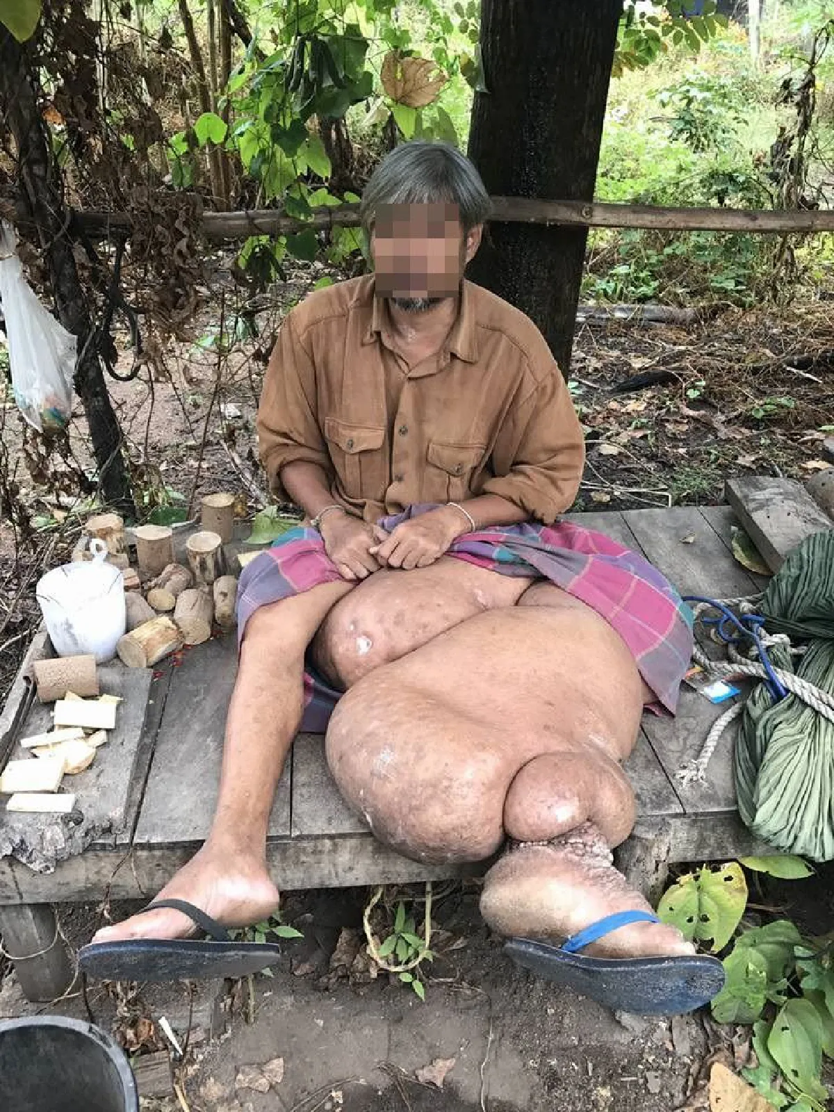 รันทด!หนุ่มป่วยโรคต่อมน้ำเหลืองอุดตันนาน10ปีจนขาบวมผิดรูป