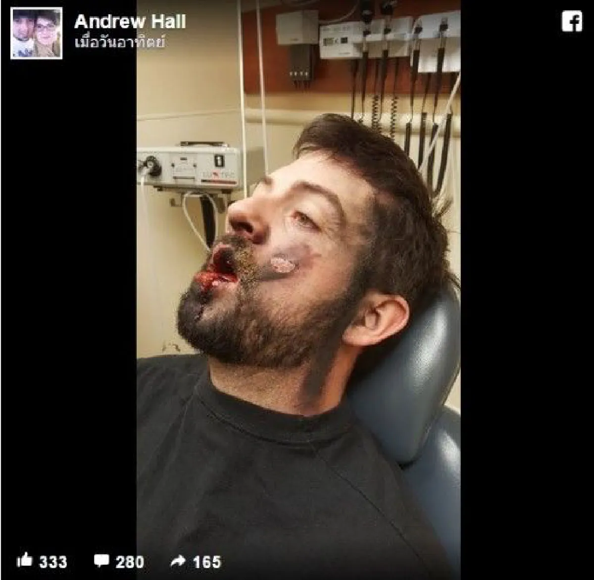 อุทาหรณ์! หนุ่มสหรัฐ บุหรี่ไฟฟ้าระเบิดคาปาก