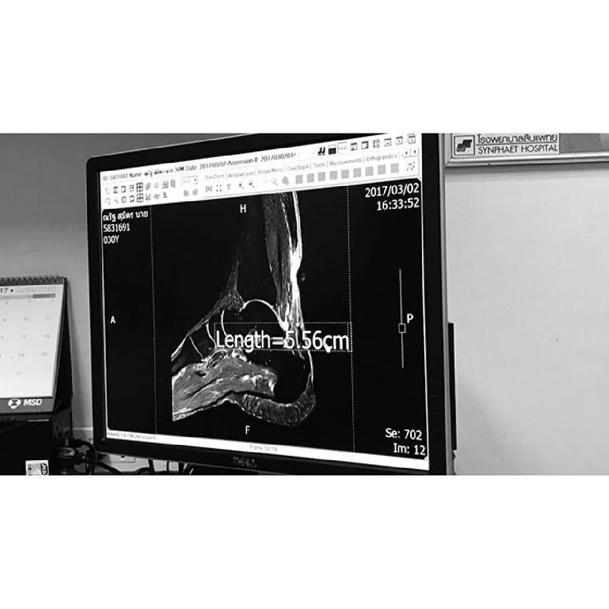 กำลังใจสำคัญ! สายป่าน โพสต์ซึ้งหลัง อาเบ ออกจากห้องผ่าตัด