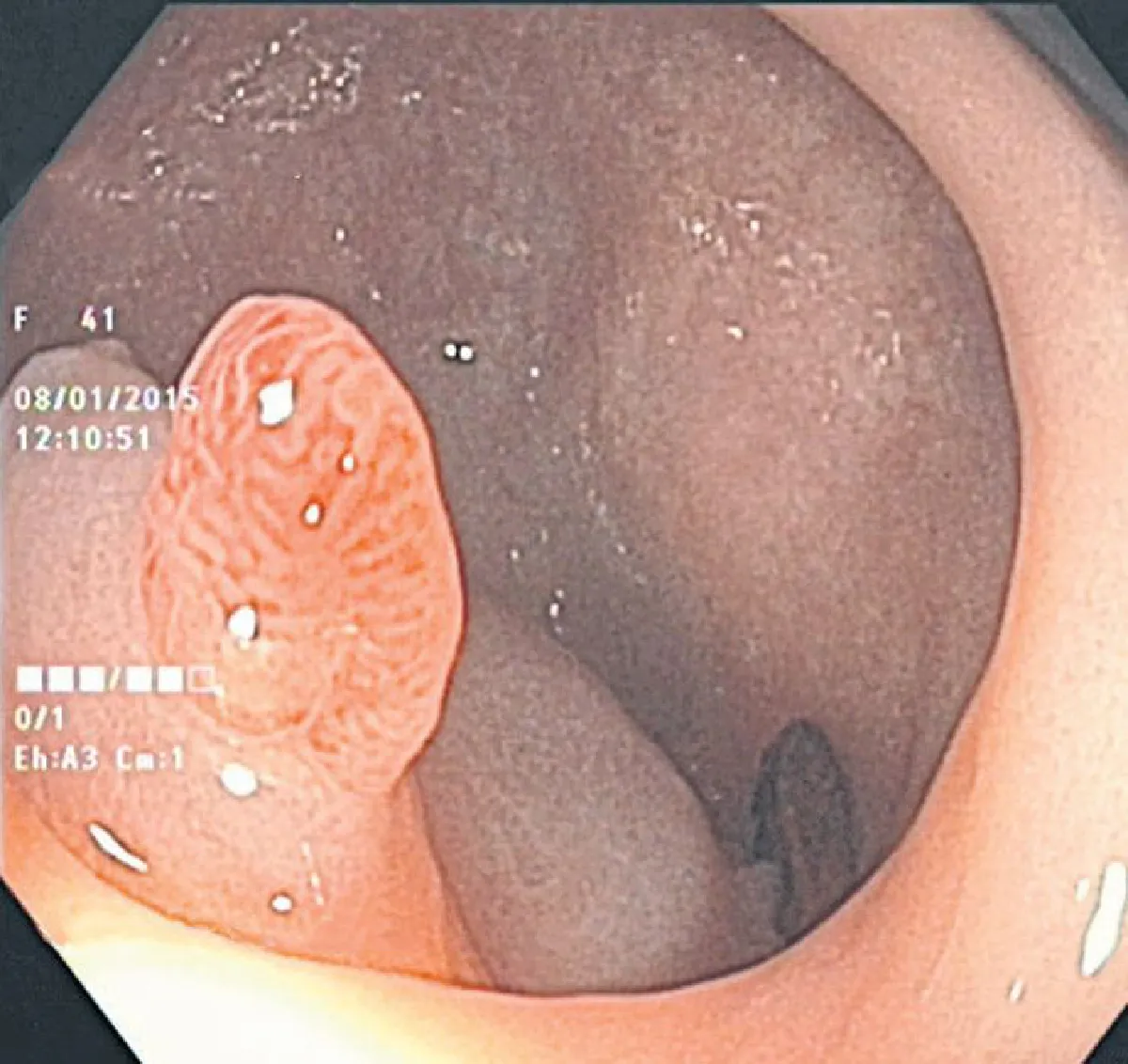 ส่องกล้องตัดก้อนเนื้อ ผ่ามะเร็งลำไส้ไม่ต้องเปิดหน้าท้อง