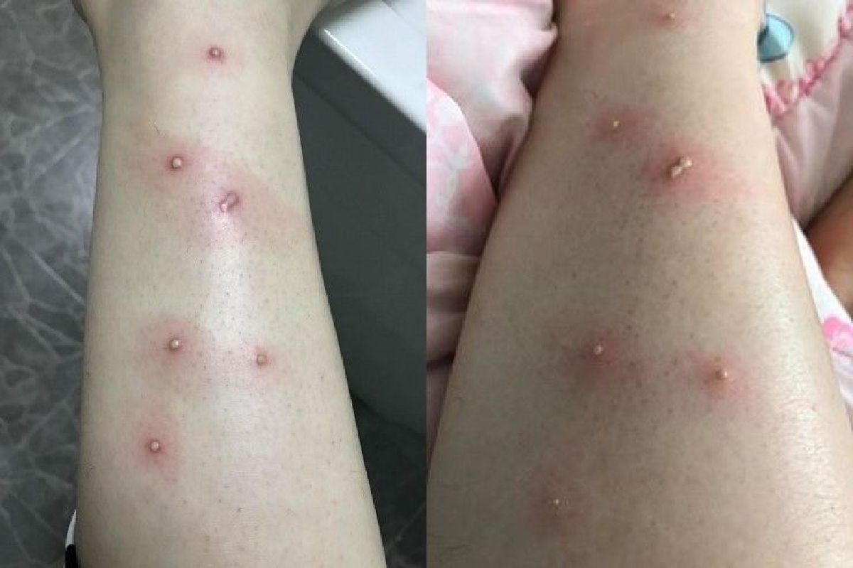 อุทาหรณ์! สาวเผยถูกเเมลงกัดในโรงหนังจนเกิดตุ่มหนองเต็มขา อุทาหรณ์! สาวเผยถูกเเมลงกัดในโรงหนังจนเกิดตุ่มหนองเต็มขา
