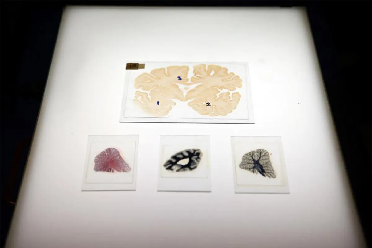 พาร์กินสัน  บำบัดสั่นด้วยศิลปะ