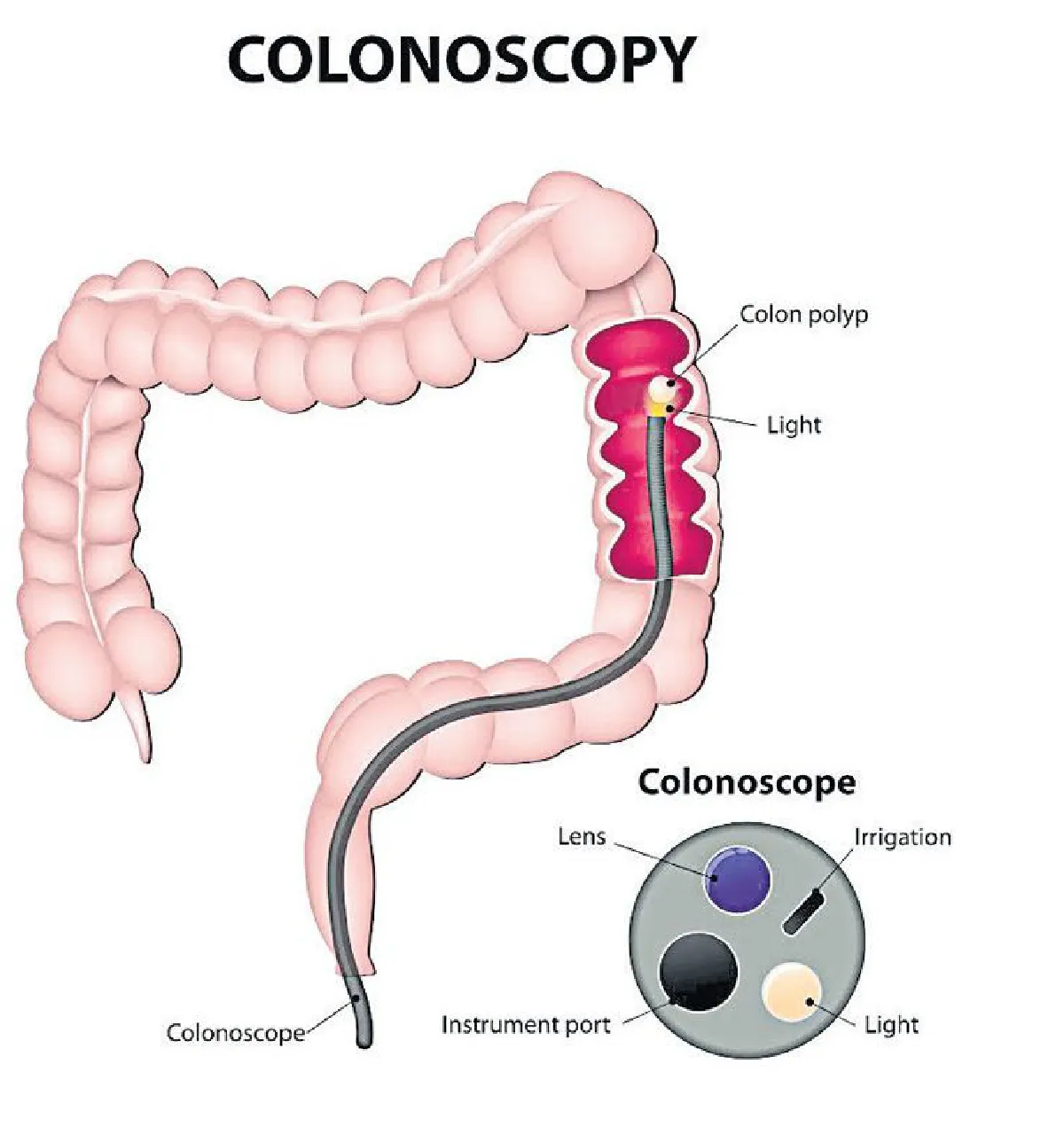‘มะเร็งลำไส้ใหญ่’ ใกล้ตัวกว่าที่คิด