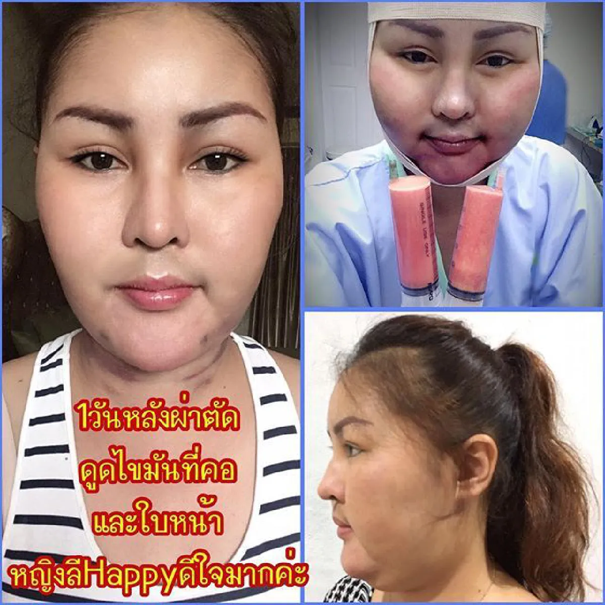 เจ็บก็ต้องทน! หญิงลี เผยหายใจโล่งขึ้นหลังดูดไขมันใบหน้าและลำคอ