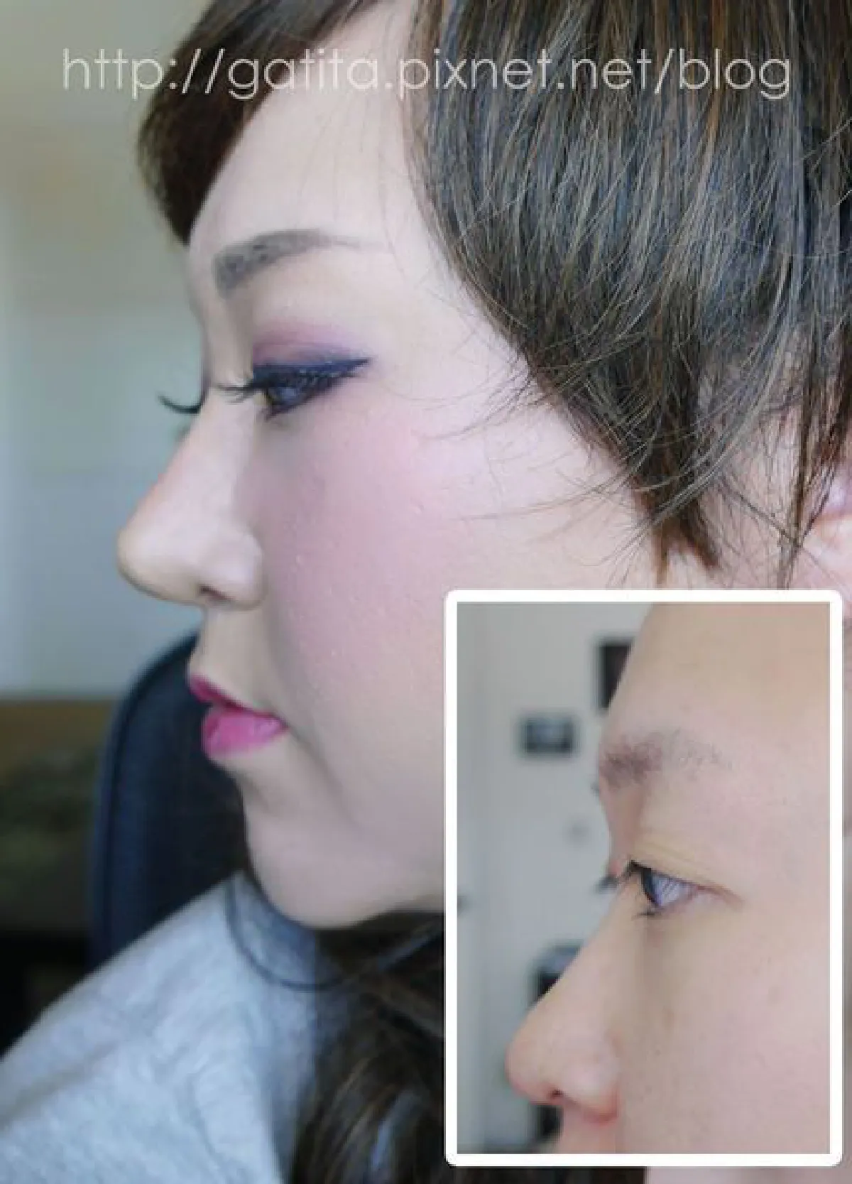 ดั้งพุ่งไม่ง้อมีดหมอ ด้วยแป้งและวาสลีน