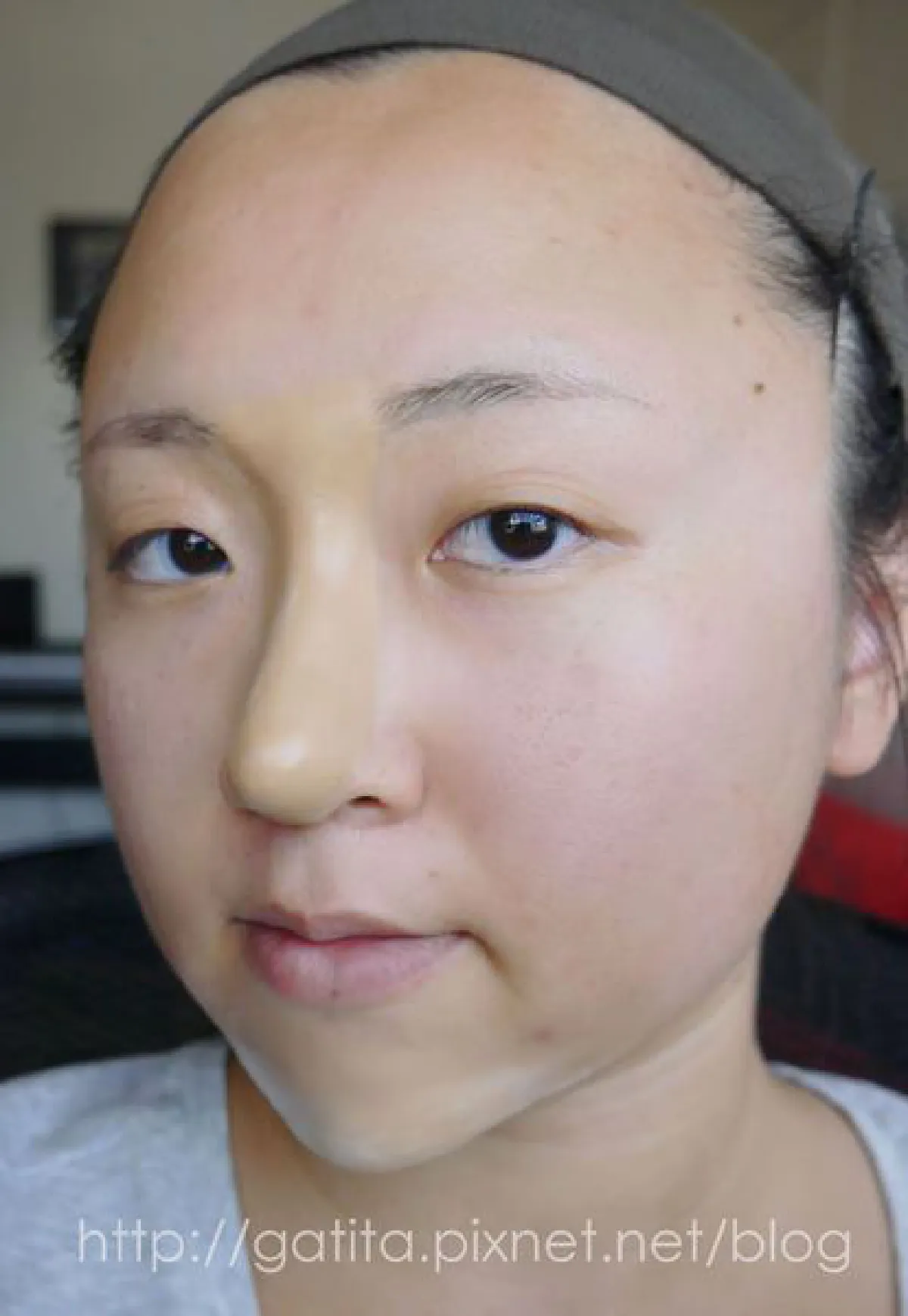 ดั้งพุ่งไม่ง้อมีดหมอ ด้วยแป้งและวาสลีน