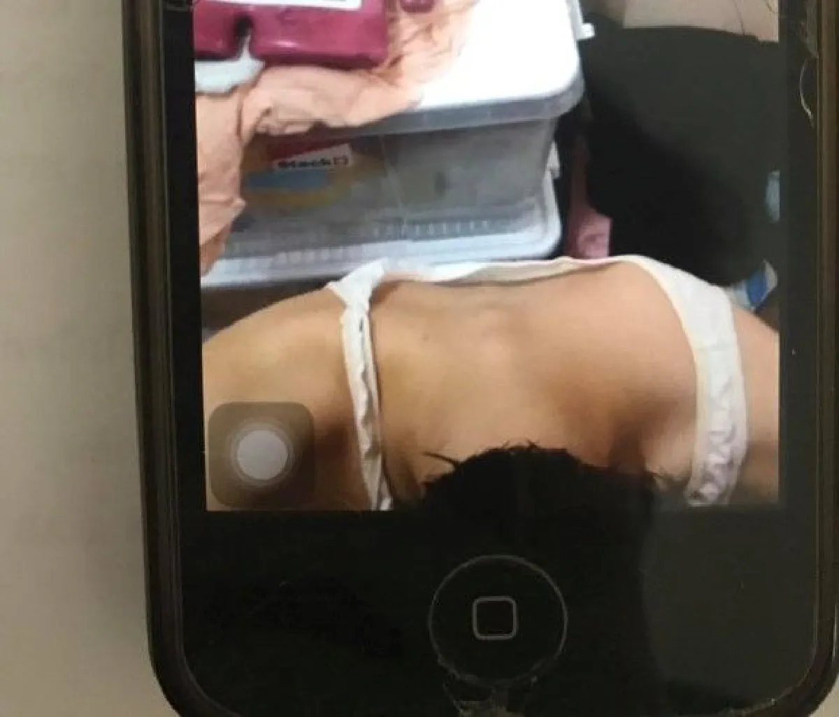 สาววัย 14 ปี เปิดประสบการณ์เลวร้ายเป็น "โรคคลั่งผอม" น้ำหนักเหลือ 33 กิโลกรัม