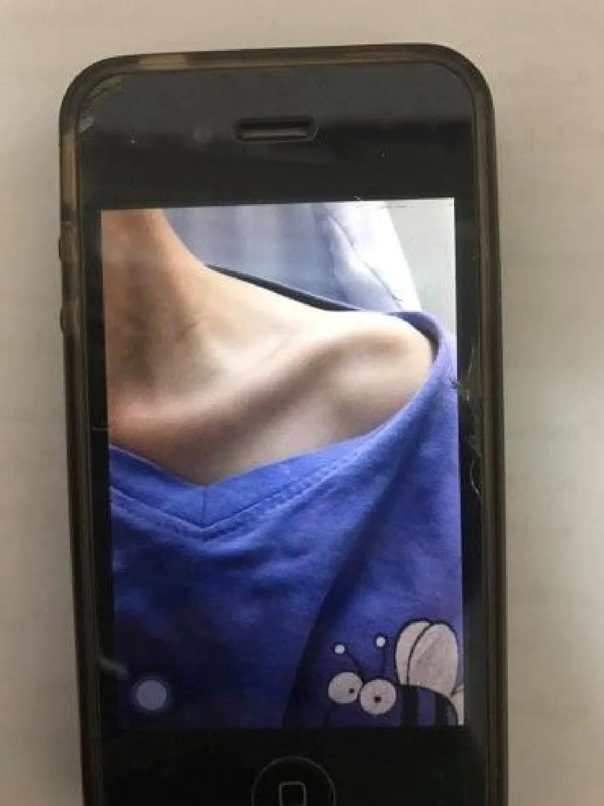 สาววัย 14 ปี เปิดประสบการณ์เลวร้ายเป็น "โรคคลั่งผอม" น้ำหนักเหลือ 33 กิโลกรัม