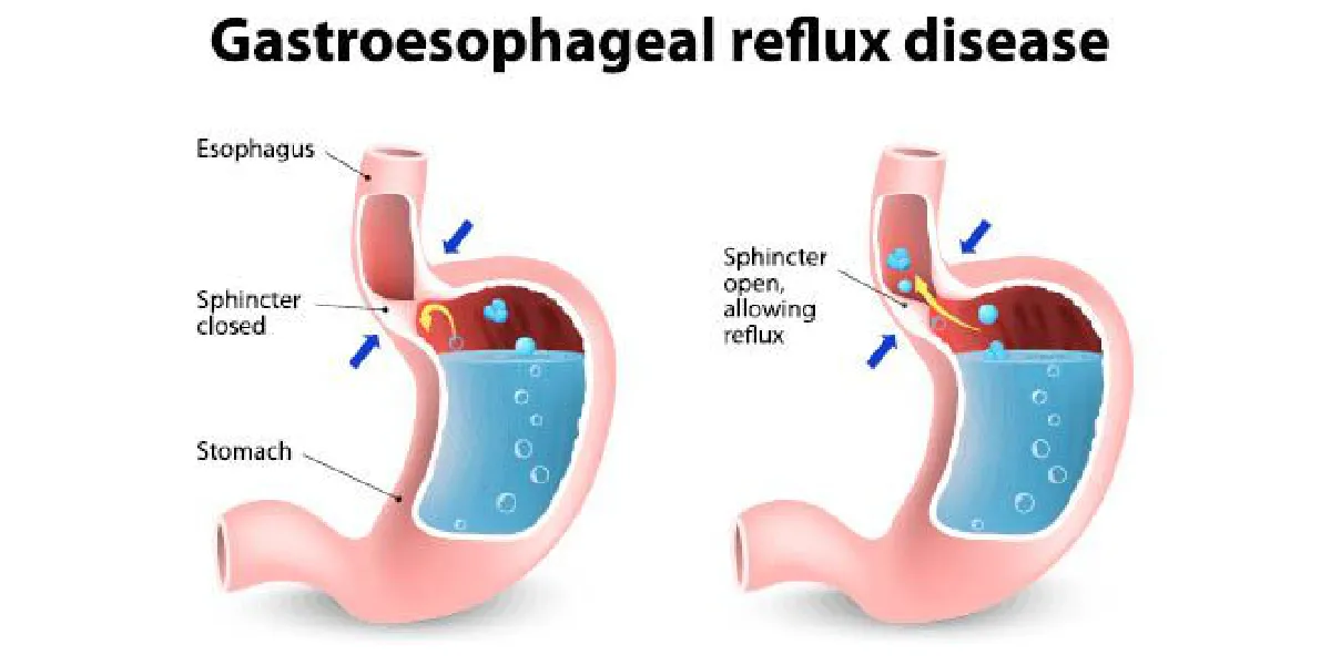 5 ปัจจัยเสี่ยงกรดไหลย้อน