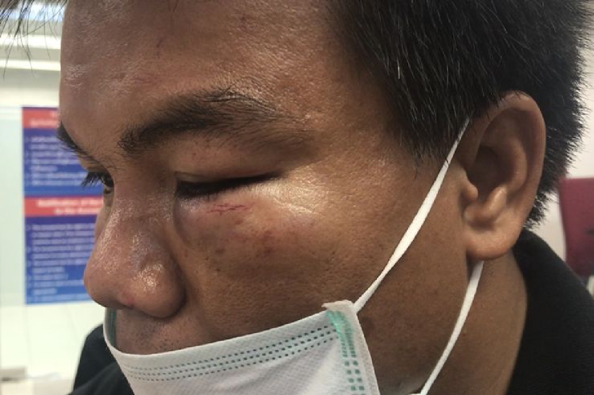 หนุ่มดูแลรถเช่าถูกชกเบ้าตาบวมในสนามบินสุวรรณภูมิ หนุ่มดูแลรถเช่าถูกชกเบ้าตาบวมในสนามบินสุวรรณภูมิ