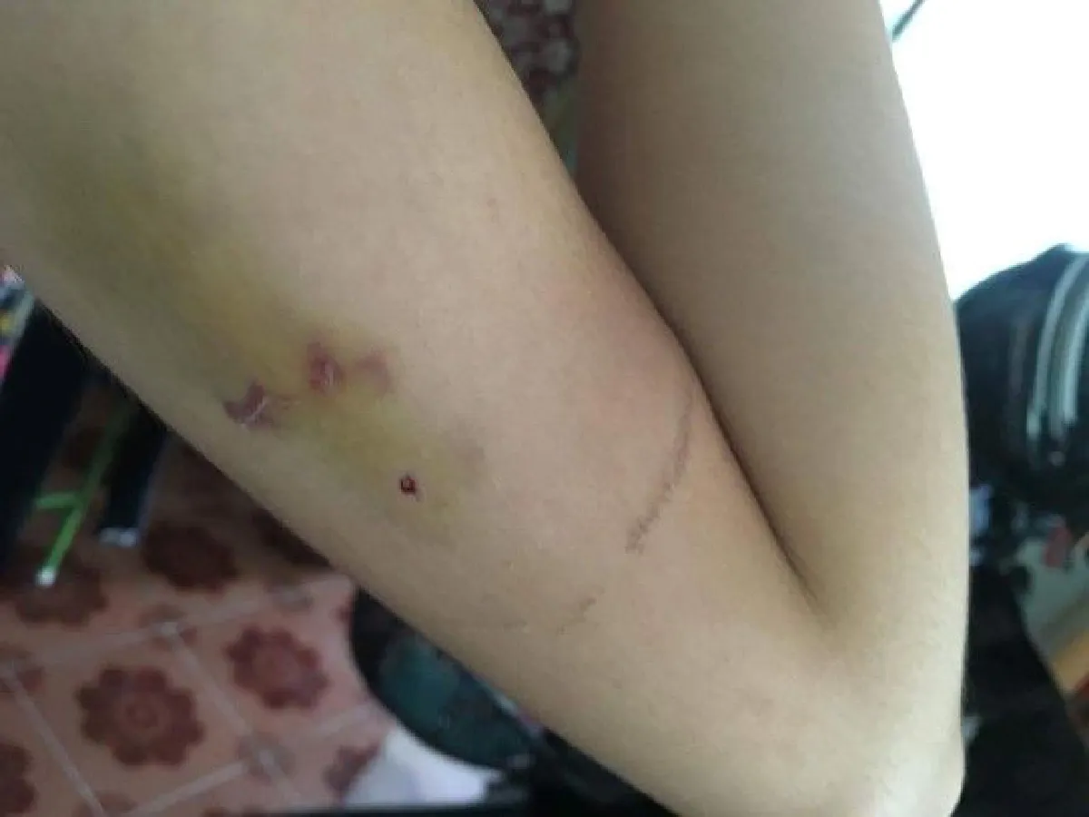 นักศึกษาสาวรีวิวการฝังยาคุมกำเนิดฟรี รับผิดชอบต่อตัวเองและสังคม