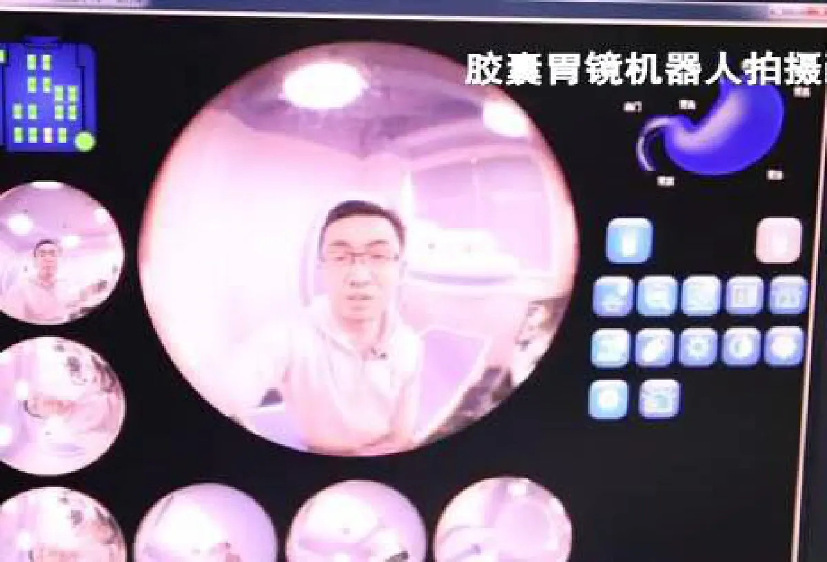 สุดล้ำ! จีนผลิตแคปซูลส่องลำไส้ ไม่ต้องทนเจ็บด้วยการส่องกล้องอีกต่อไป