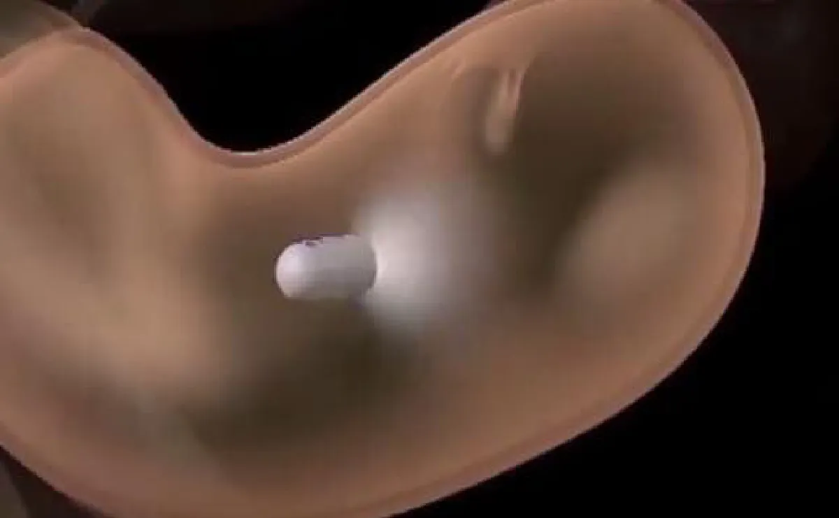 สุดล้ำ! จีนผลิตแคปซูลส่องลำไส้ ไม่ต้องทนเจ็บด้วยการส่องกล้องอีกต่อไป